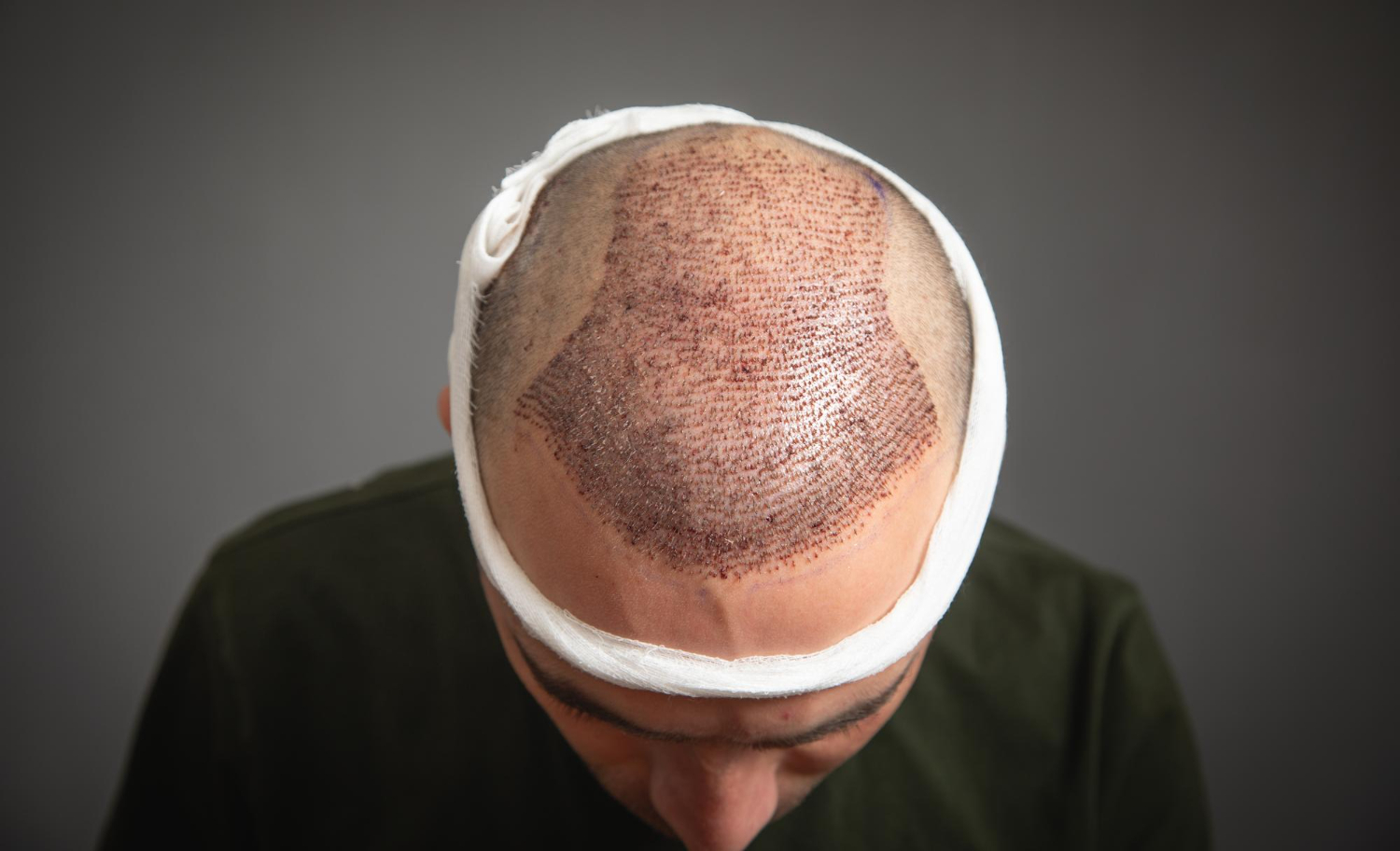 Hair Transplant Result