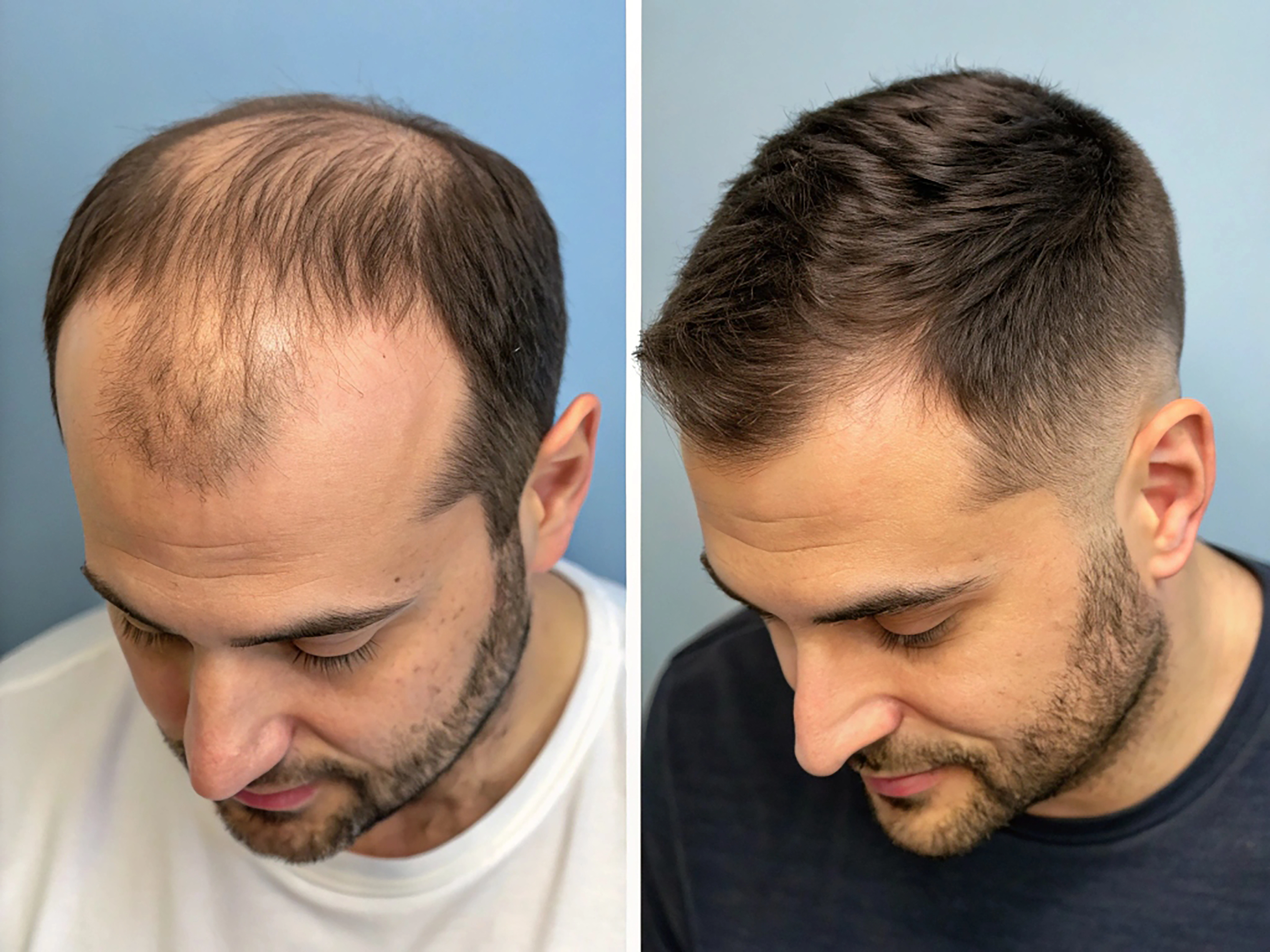 Hair Transplant Results by Best Doctors Services